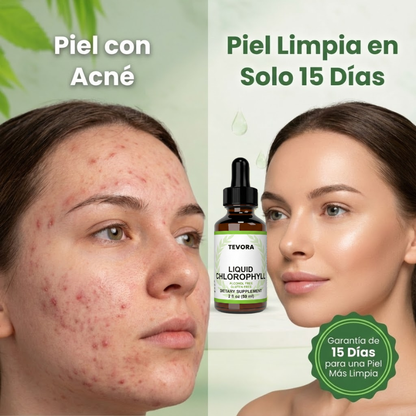 Tevora Acné Rescue™ - Elimina El Acné En 15 Días